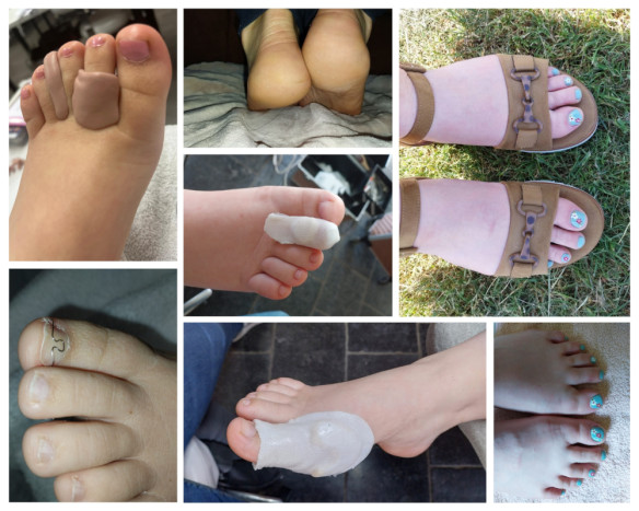 Pedicure aan huis Moerbeke (Lokeren), Oost-Vlaanderen